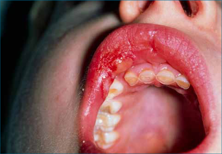Latex Allergy - Family Dental Centre