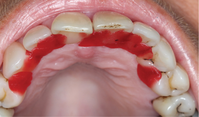 impression of the teeth marks on the sides of the tongue