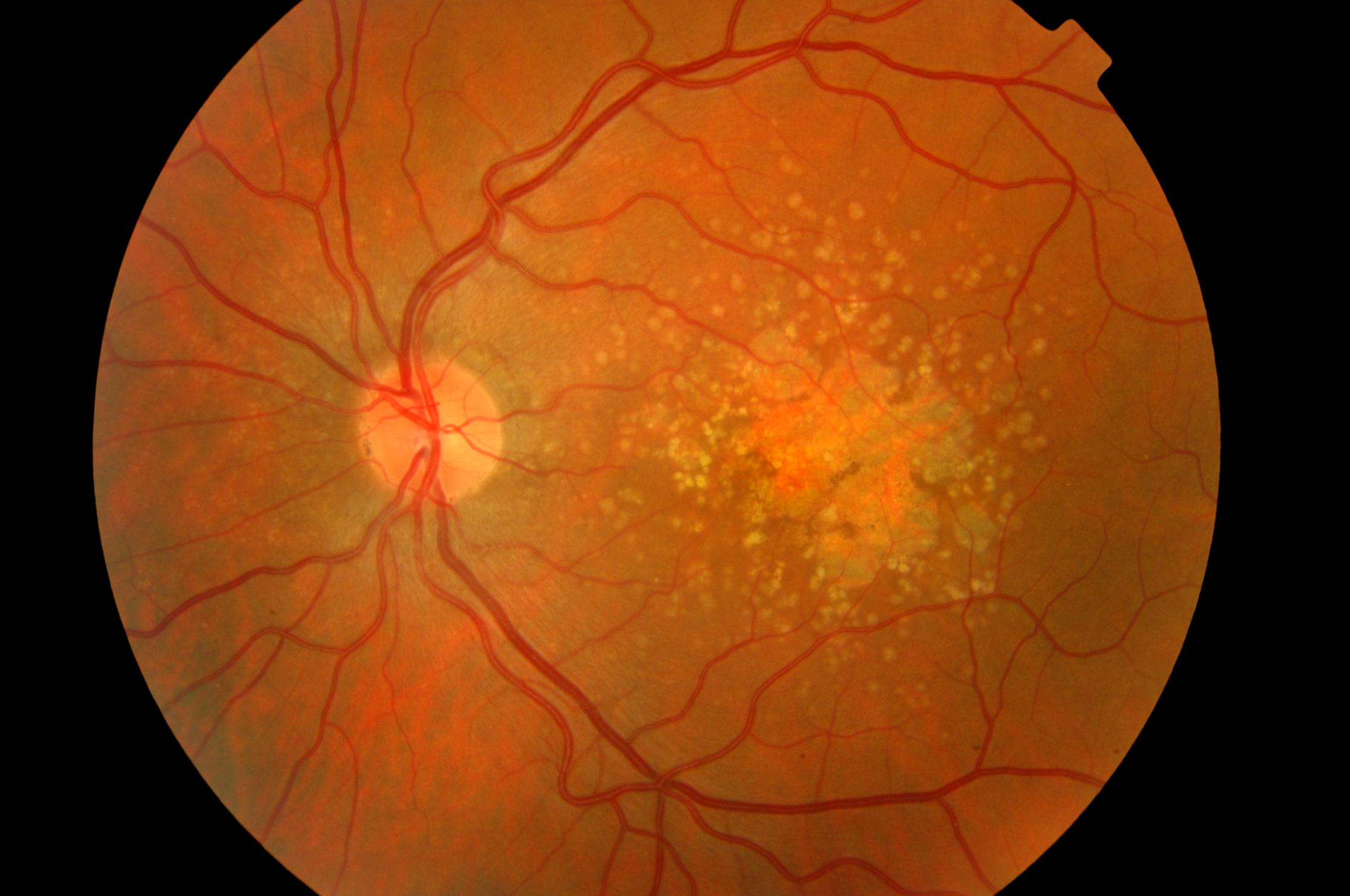 Researchers say HIV drug can be used to fight dry AMD ...