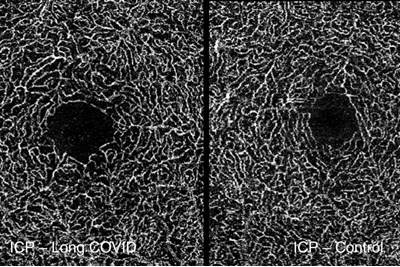 OCT-A imaging assessing retinal capillary density