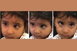 Figure 1: AD with three pictures of esotropia eyes